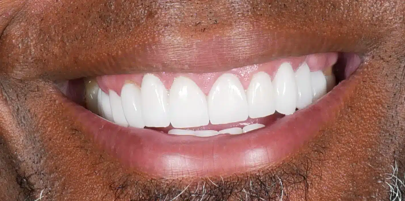 Kurt after.jpg - One Dental Group Kurt after.jpg - One Dental Group