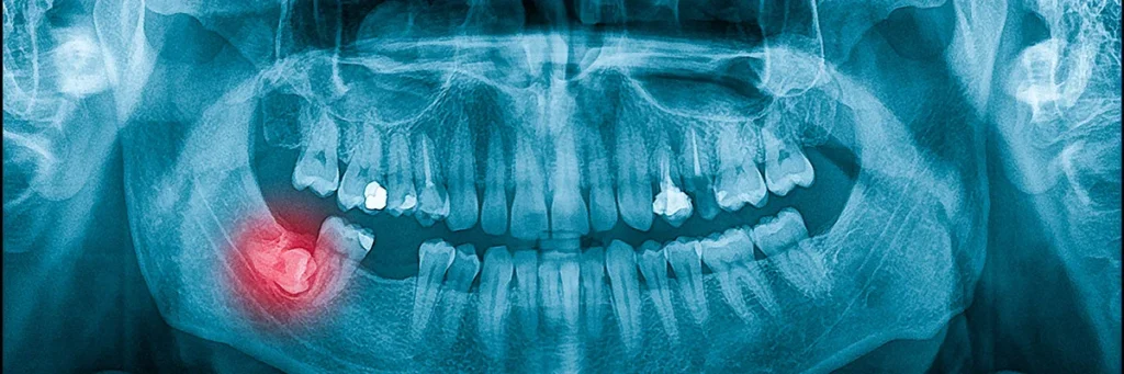 wisdom teeth extraction - One Dental Group wisdom teeth extraction